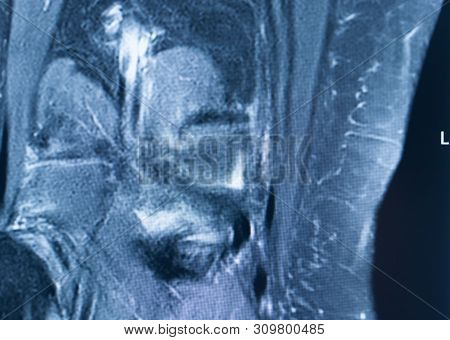 Knee Injury Mri Mcl Tear
