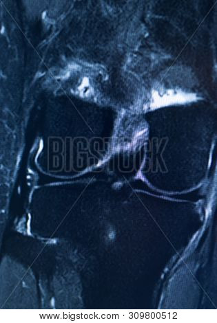 Knee Injury Mri Mcl Tear