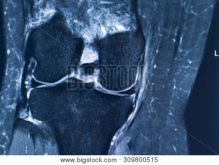Knee Injury Mri Mcl Tear