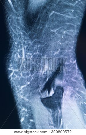 Knee Injury Mri Mcl Tear