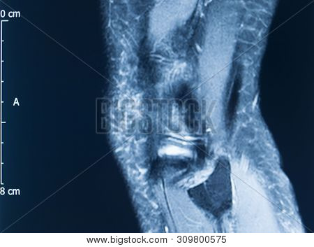 Knee Injury Mri Mcl Tear