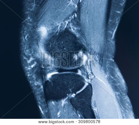 Knee Injury Mri Mcl Tear