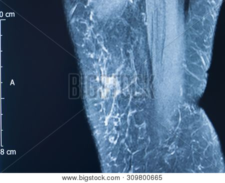 Knee Injury Mri Mcl Tear