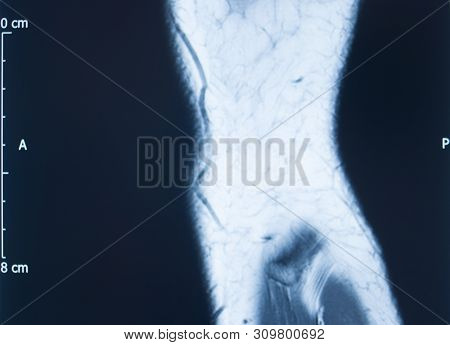 Knee Injury Mri Mcl Tear