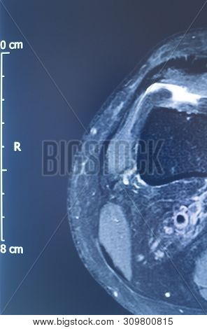 Knee Injury Mri Mcl Tear