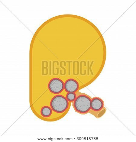 Stones In Kidneys. Nephrolithiasis Kidney Stones Disease. Medical Vector Illustration
