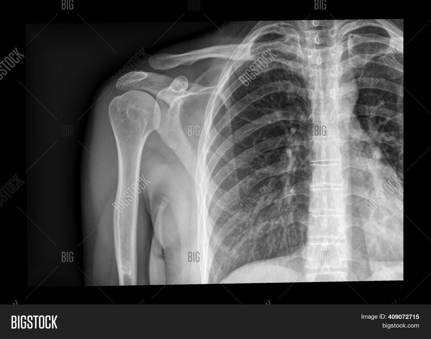 Xray Shoulder Image & Photo (Free Trial) Bigstock