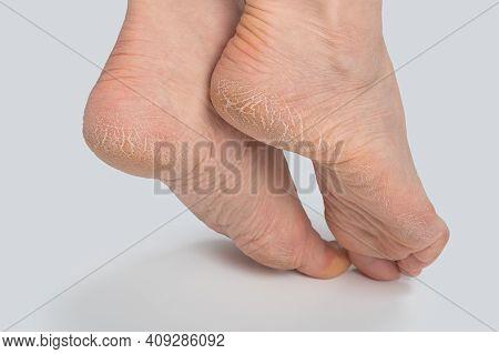 Dry And Cracked Soles Of Feet On White Background, Womans Feet With Dry Heels, Cracked Skin. Close U