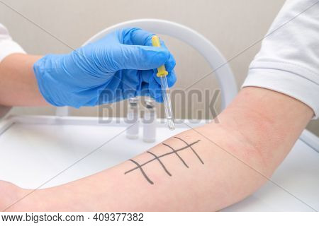 Immunologist Doing Skin Prick Allergy Test. Redness And Peeling On The Arm.