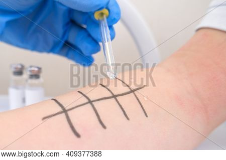 Immunologist Doing Skin Prick Allergy Test. Redness And Peeling On The Arm.
