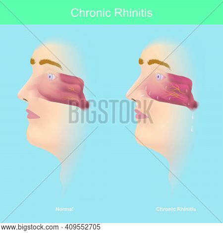 Chronic Rhinitis. This Illustration Medical Use For Explain Comparison Chronic Rhinitis Symptoms Hav