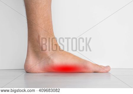 Foot Pain Because Of Strong Flat Feet Also Called Pes Planus Or Fallen Arches. The Arches On The Ins