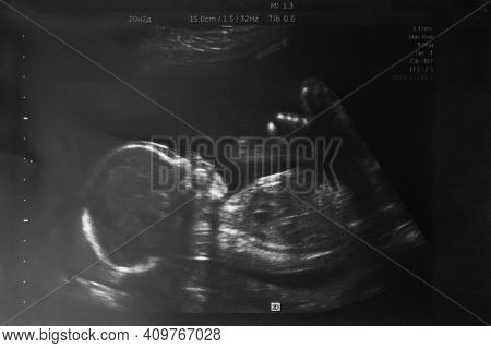 Image Of Baby In Mother's Womb During Ultrasound Examination At 20 Weeks 2 Days.