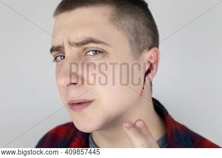 A Man Whose Ear Is Bleeding. Vascular Rupture, Damage To The Tympanic Membrane, Ear Diseases, Oncolo
