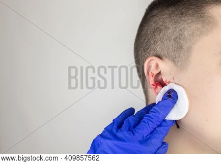 A Man Whose Ear Is Bleeding. Vascular Rupture, Damage To The Tympanic Membrane, Ear Diseases, Oncolo