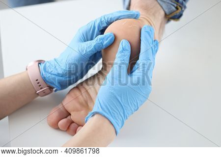 Doctor Dermatologist In Gloves Examining Patients Heel Closeup. Treatment Of Cracked Heels Concept