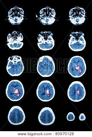 Hemorrhagic Stroke .  Ct Scan (computed Tomography) Of Brain