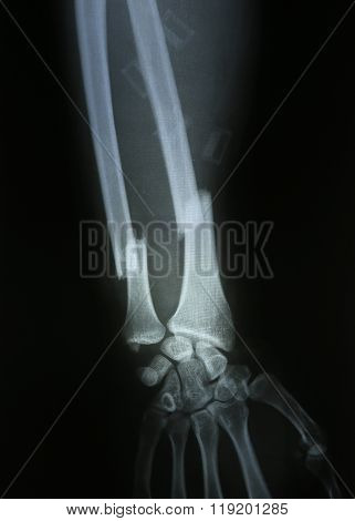 X-ray photos of bone in patient