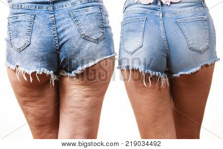 Comparison of female legs thighs with and without cellulite. Skin problem body care overweight and dieting concept.