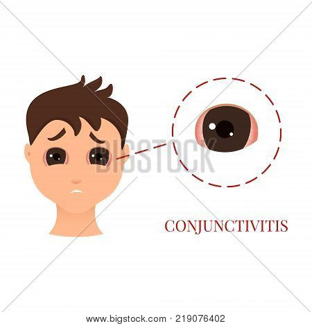 Man with conjunctivitis. Closeup view. Sad patient with pinkeye. Infectious viral disease. Medical concept. Anatomy of people. Vector illustration.