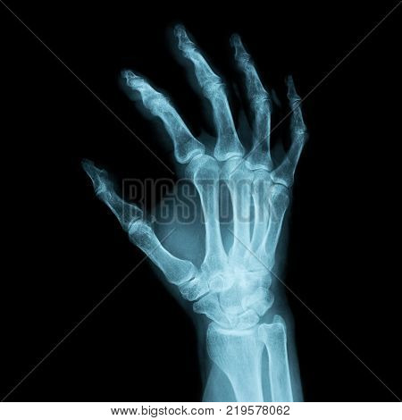 right human hand X-ray image from a human body part for medical diagnosis. ideal for websites and magazines layouts