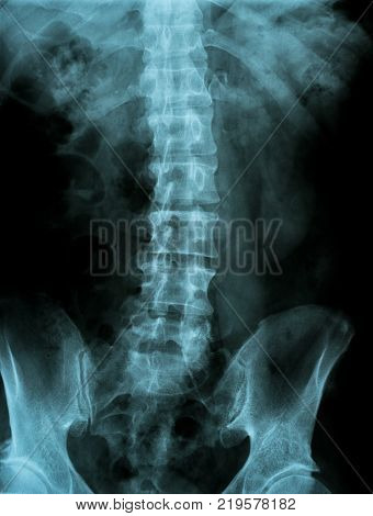 pelvis and spinal column X-ray image from a human body part for medical diagnosis. ideal for websites and magazines layouts