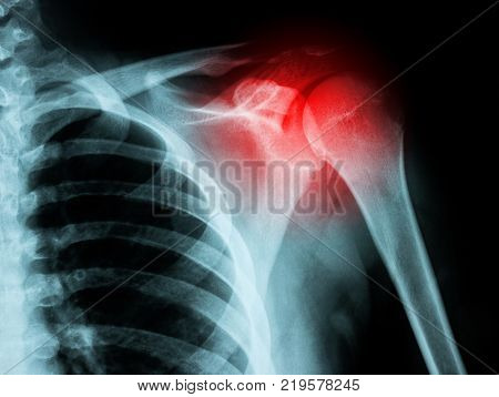 right shoulder fracture with red pain point X-ray image from a human body part. ideal for websites and magazines layouts