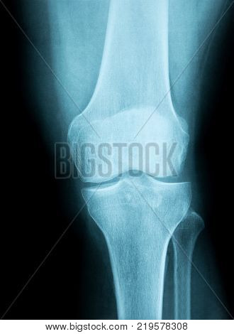 left knee joint X-ray image from a human body part. ideal for websites and magazines layouts