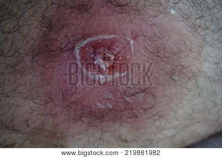 Pimple Extreme Macro with growing hairs  of an object