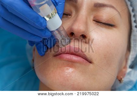 Cosmetic treatment by injection in the clinic. Use of a dermal injector to stimulate the skin. A woman receives injections of a placental-peptide serum