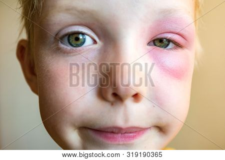 Big Red Bruise Under The Boy