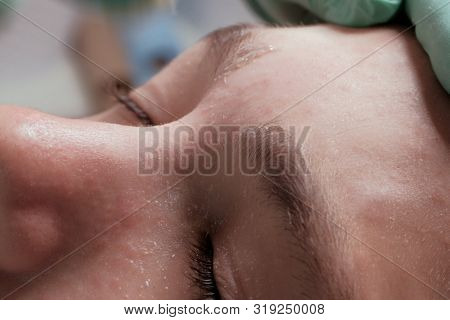 Clean Skin Without Hair Between The Eyebrows On The Bridge Of The Nose. The Procedure For Completing