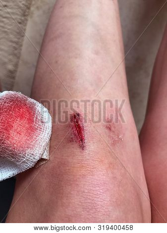 Close Up Of Cut Wound At Leg. Health Care Concepts.