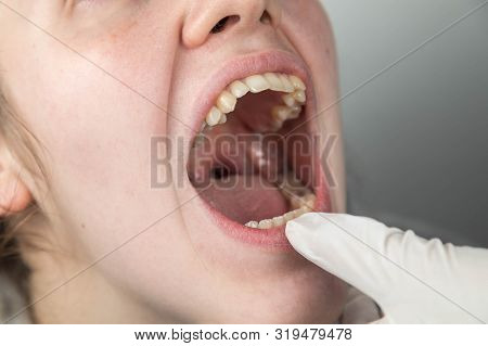 Problem Teeth At The Young Girl. A Curve Row And The Wrong Bite An Occasion To Visit The Dentist And