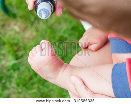 Treat A Child S Wound. Treat A Wound To A Small Child. Injured Leg Of The Child, Abrasions In The Ch