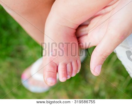 Treat A Child S Wound. Treat A Wound To A Small Child. Injured Leg Of The Child, Abrasions In The Ch