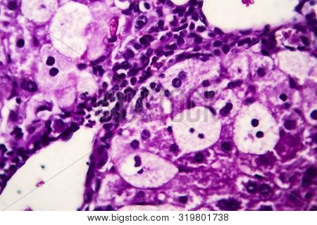 Histopathology Of Acute Hepatitis, Light Micrograph, Photo Under Microscope. High Magnification