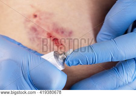 Doctors Hands In Gloves Performs The Treatment The Wound With The Help Of Ointment. Hematoma Of Tiss