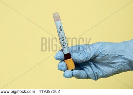 Blood Sample In A Vacuum Tube For Hemoglobin Hba1c Test  Diabetes Diagnosis