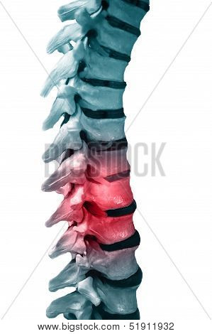 Back Pain
