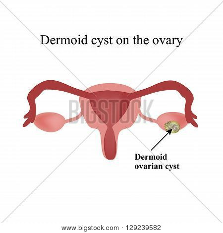 Dermoid cyst on the ovary. Ovary. Infographics. Vector illustration on isolated background.