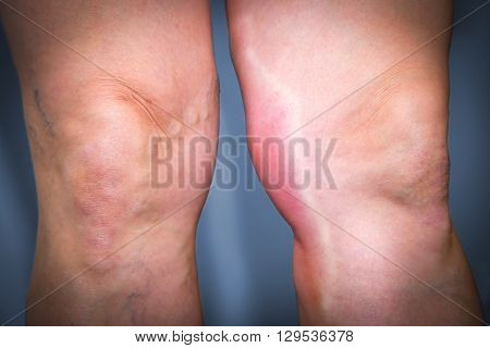 Thrombophlebitis In Human Leg
