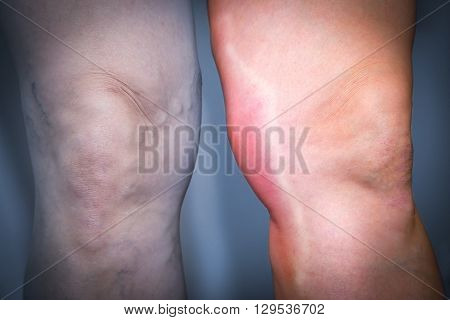Thrombophlebitis In Human Leg