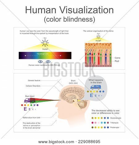 Human Can See The Color From Wavelength Of Light
The Destruction Of The Retina Or Perception In The 