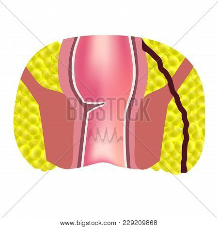 Types Of Fistulas Of The Rectum. Paraproctitis. Anus. Abscess Of The Rectum. Infographics. Vector Il