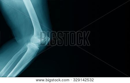 X-ray Image Of Oa Knee With Banner Design