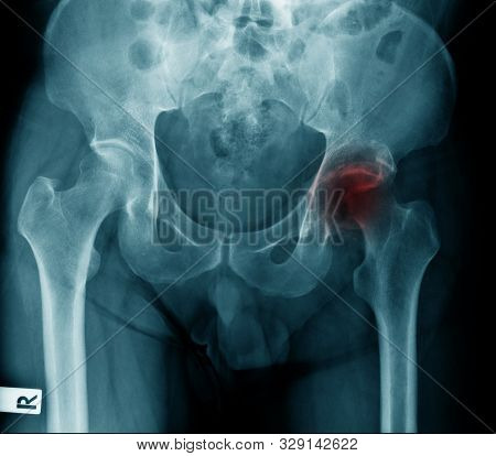 X-ray Image Of Old Woman Show Degenerative Change Of Hip Joint, Hip Avascular Necrosis Right Side Of
