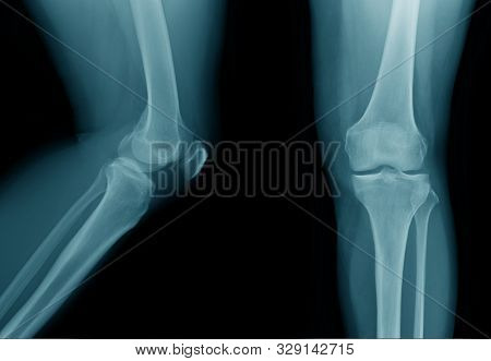 High Quality X-ray Knee Joint Of Old Man, Oa Knee Of Old Man On Black Background In Blue Tone