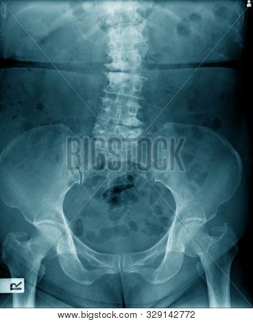 Old Man X-ray, Lumbar X-ray Image With Pelvic Bone In Blue Tone