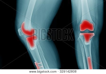 X-ray Image Of Oa Knee With Banner Design, Tka X-ray Image